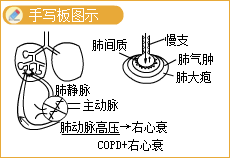 Rt(y)(sh)`ܿ}Էμ(COPD)\